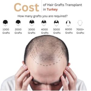 cost of hair transplant